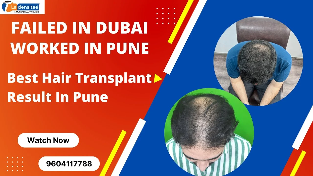 Best Hair Transplant in Pune|| Best Hair Transplant Clinic in Pune