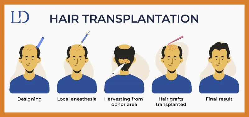 Hair Transplantation Procedure