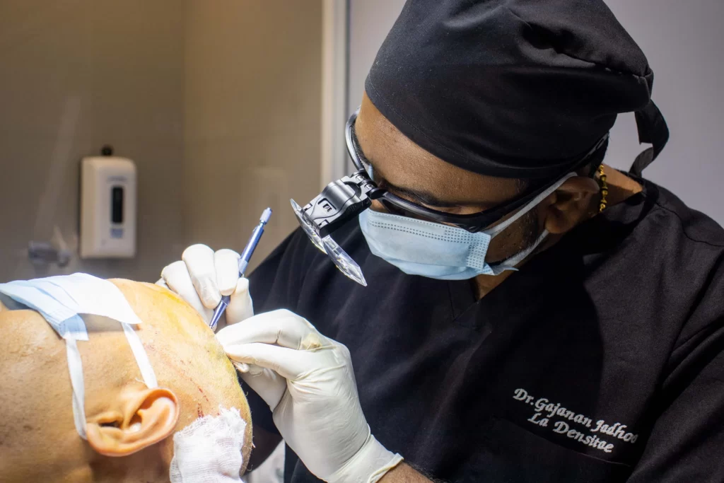 A person getting a hair transplant treatment at La Densitae Hair, Skin & Laser Clinic in Pune by FUE Sapphire Hair Transplant