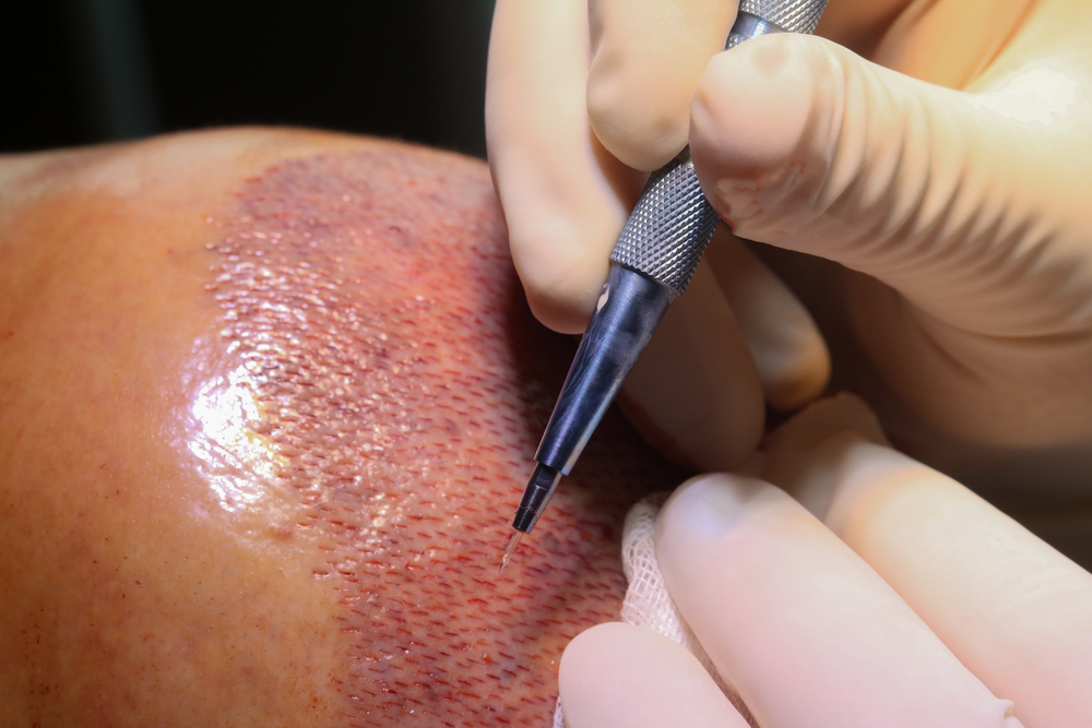 Sapphire Follicular Unit Extraction being done at LaDensitae hair Transplant Clinic