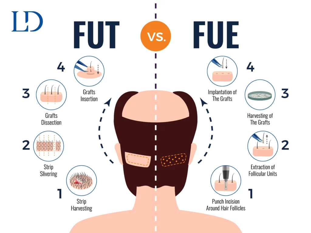 FUE vs FUT For website