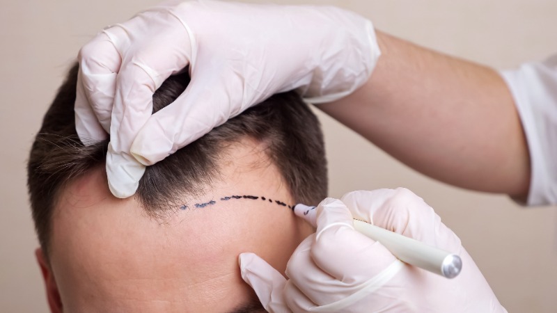 marking on scalp for 