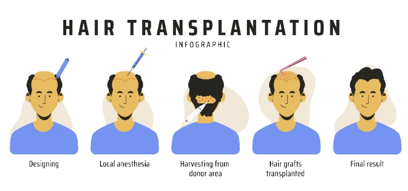 The Hair Transplant process