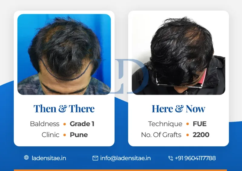 Quality and Natural-Looking Results after hair transplant