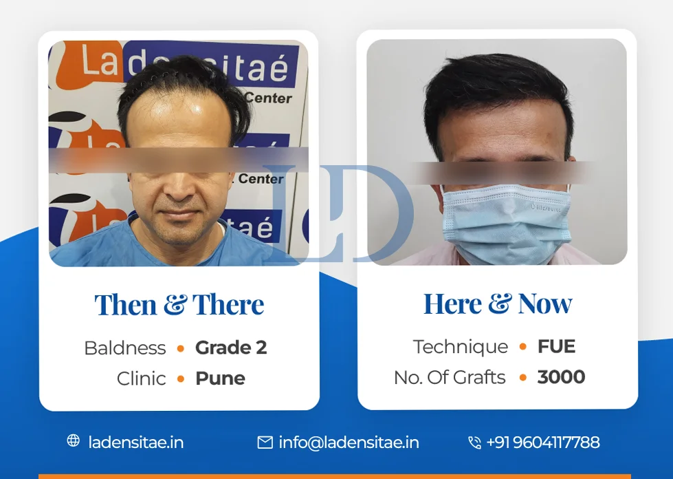 the best hair transplant results in India before and after LaDensitae (1)