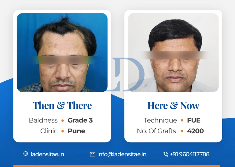 the best hair transplant results in India before and after LaDensitae (15)