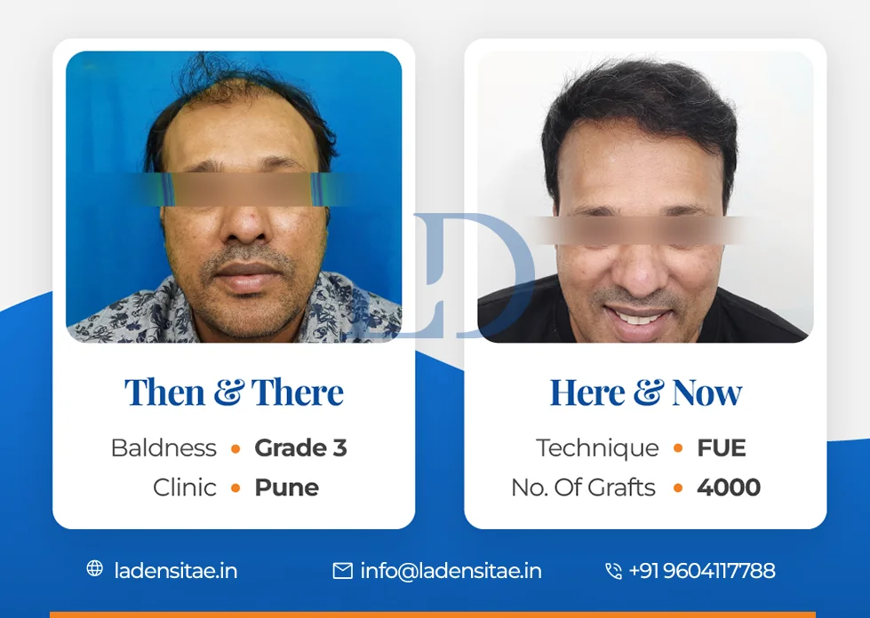 the best hair transplant results in India before and after LaDensitae (37)