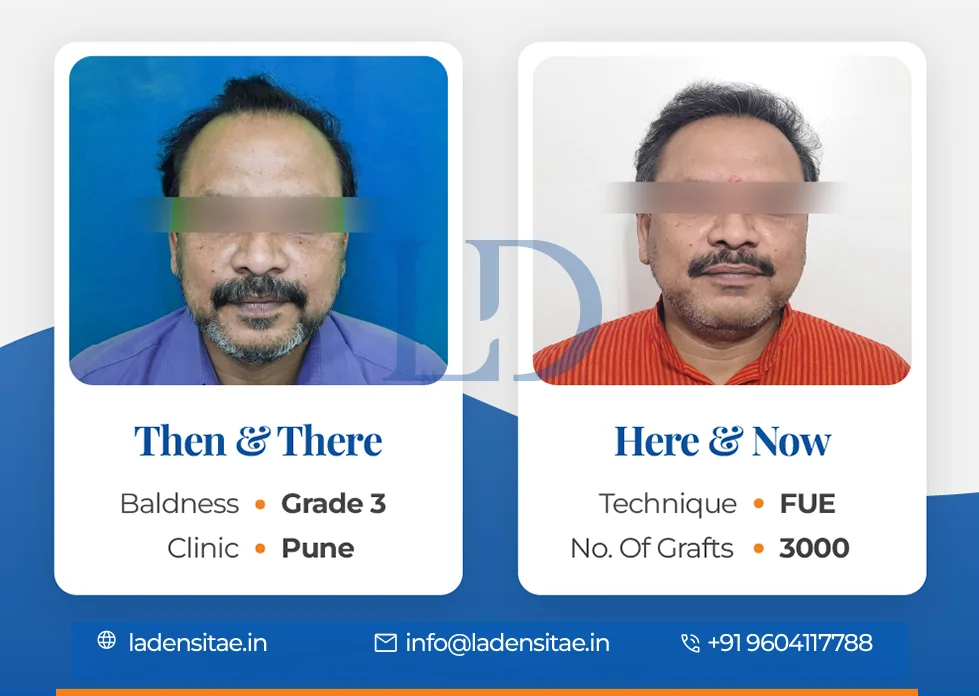 the best hair transplant results in India before and after LaDensitae (38)