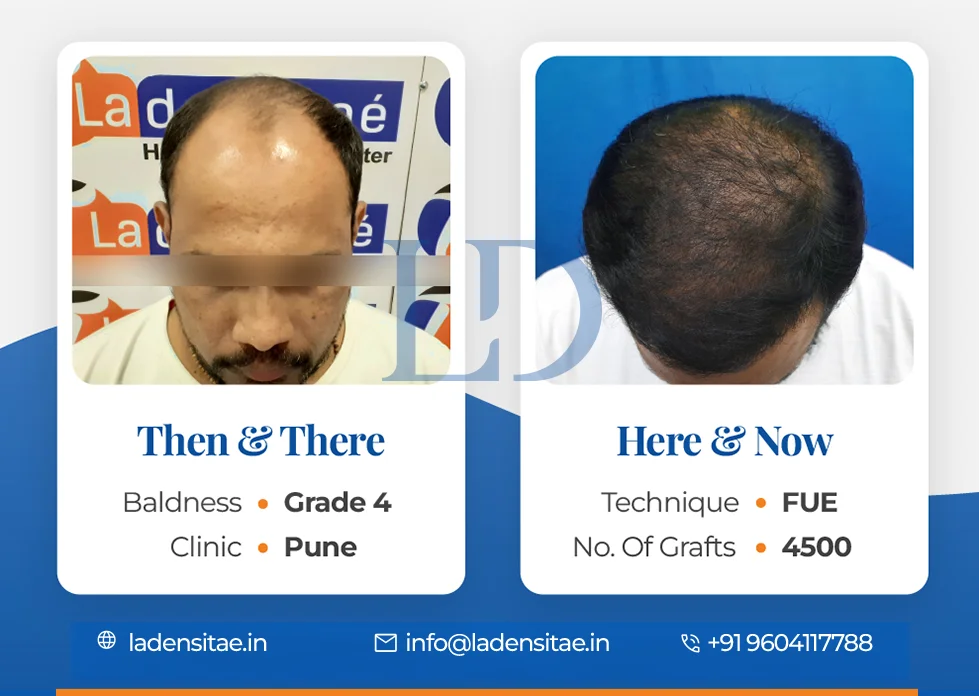 the best hair transplant results in India before and after LaDensitae (4)