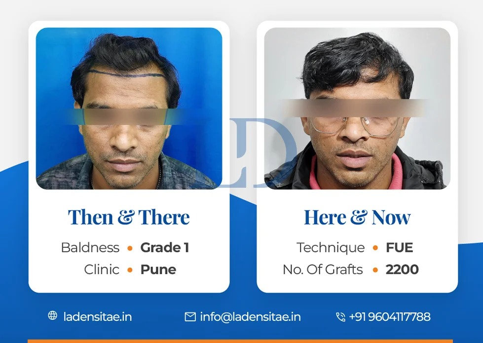 the best hair transplant results in India before and after LaDensitae (44)