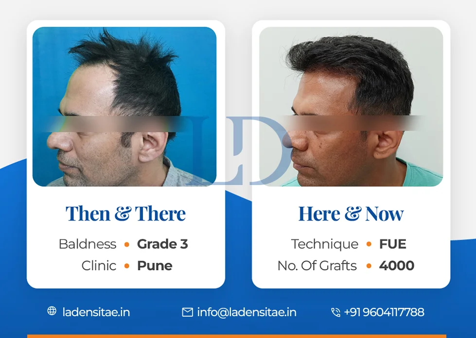 the best hair transplant results in India before and after LaDensitae (49)