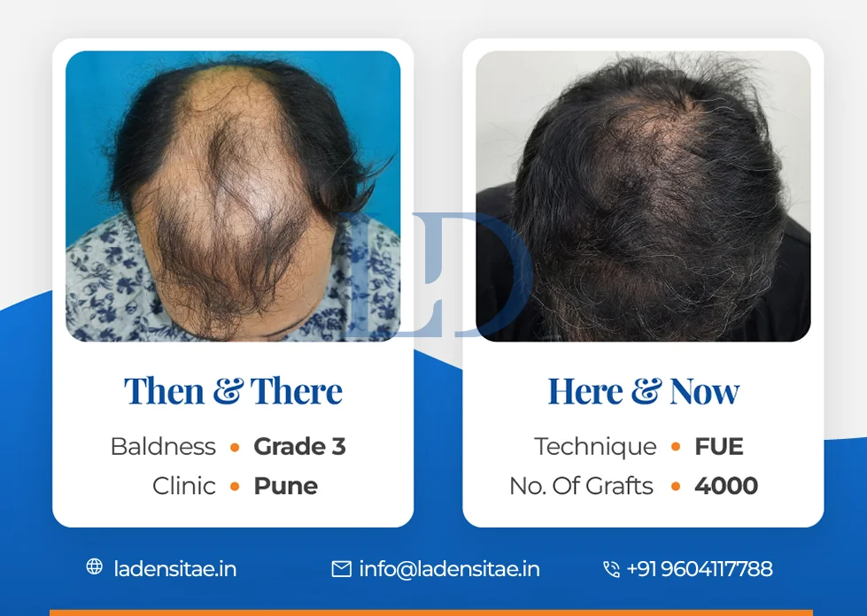 the best hair transplant results in India before and after LaDensitae (52)
