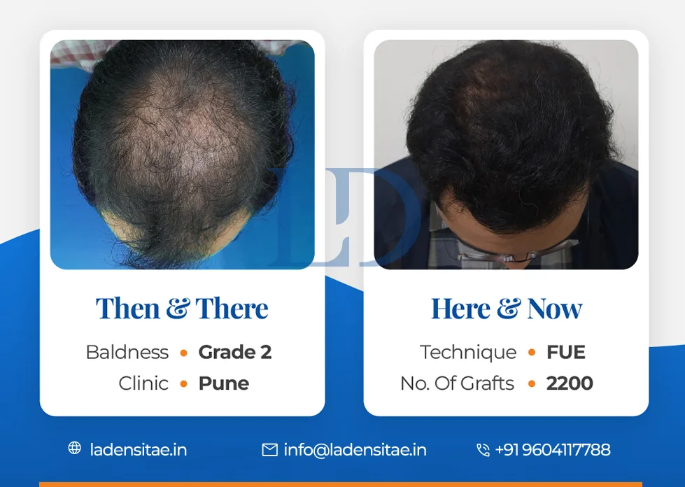 the best hair transplant results in India before and after LaDensitae (7)
