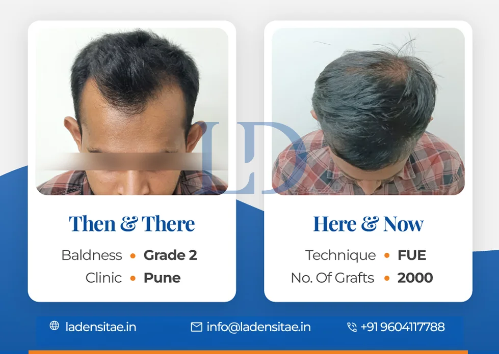 the best hair transplant results in India before and after LaDensitae (9)