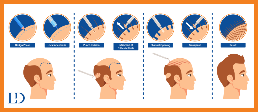 The Hair Restoration Process