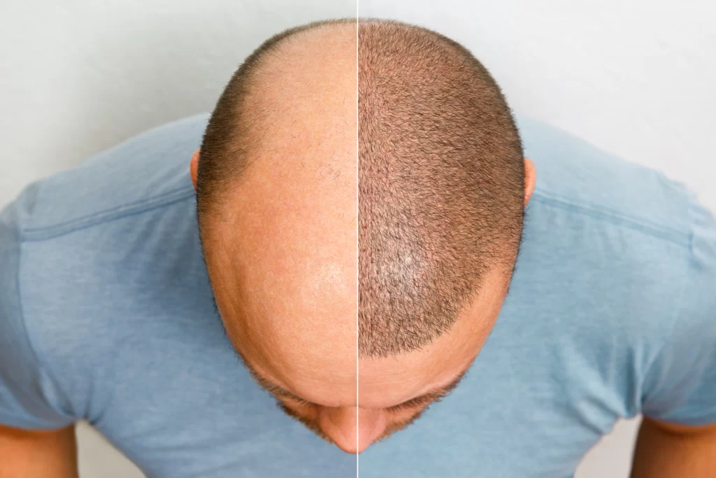 head balding man before after hair transplant surgery m