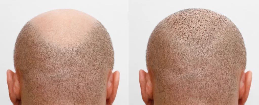 head balding man before after hair transplant surgery man losing his (1)