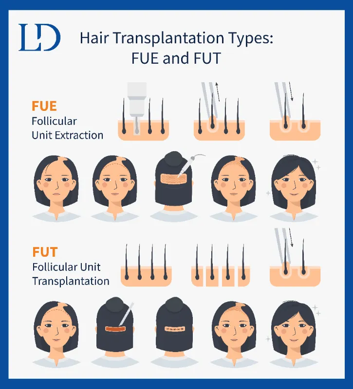 FUE Hair Transplant Procedure