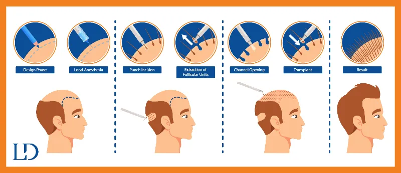 Understanding Hair Transplantation: