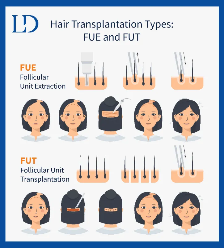 hair transplantation FUE and FUT