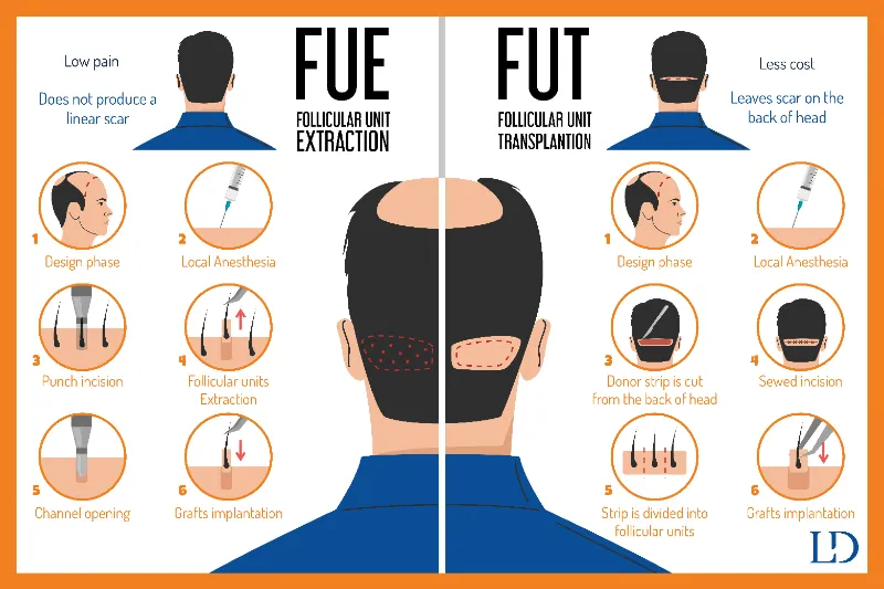 Follicular Unit Transplantation (FUT) and Follicular Unit Extraction (FUE)