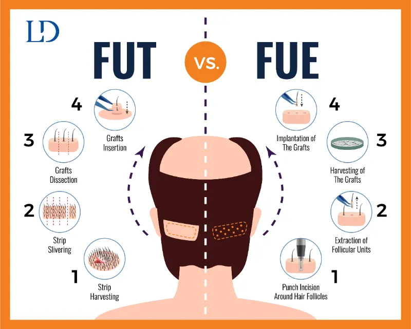 FUE vs. FUT: Understanding the Techniques