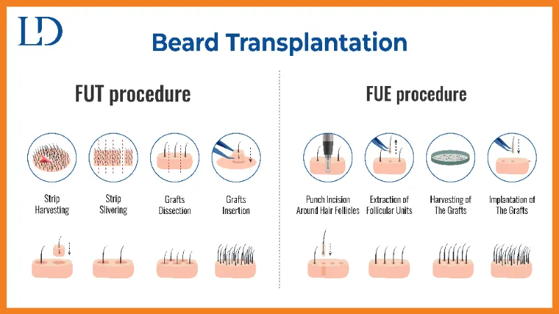 Different Techniques Used in Beard Transplantation