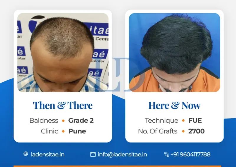 Natural Look with Hair Transplants