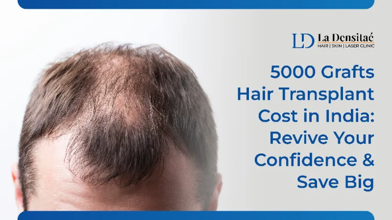 500 Grafts Hair Transplant Cost India