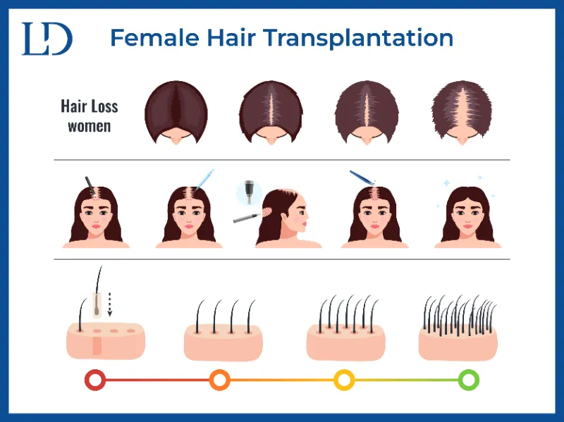Understanding Female Hair Transplantation