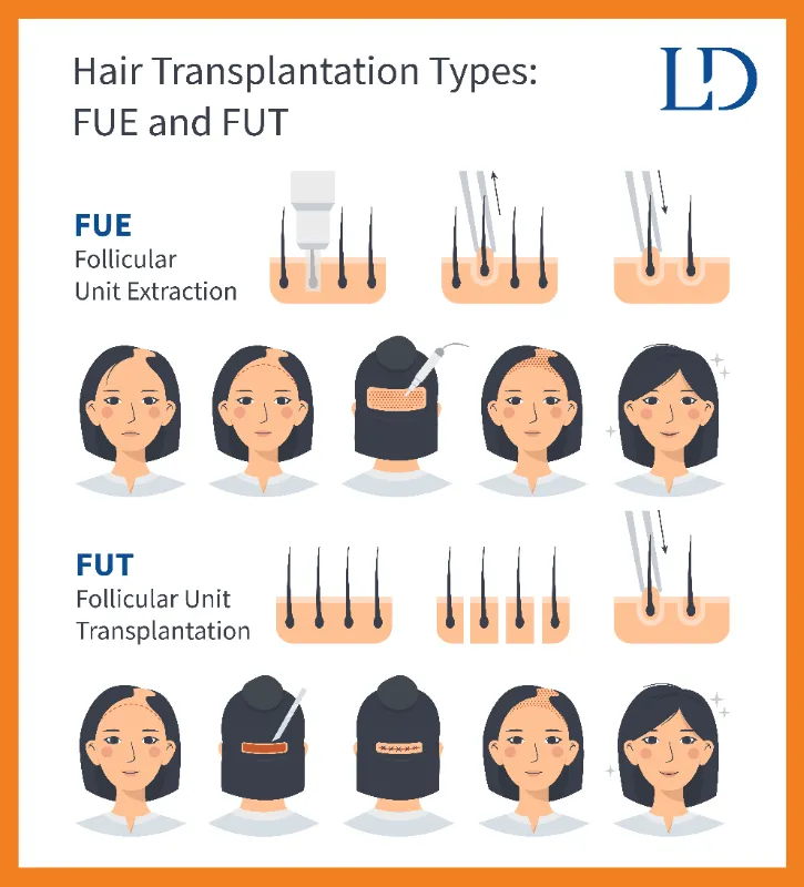 Different Types of Female Hair Transplants and Costs