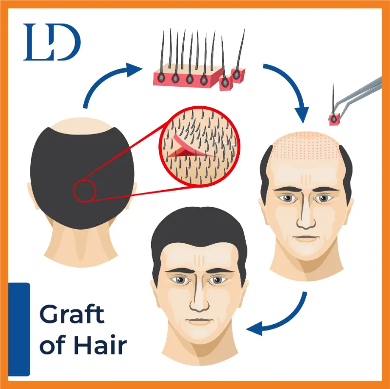  graft of hair 