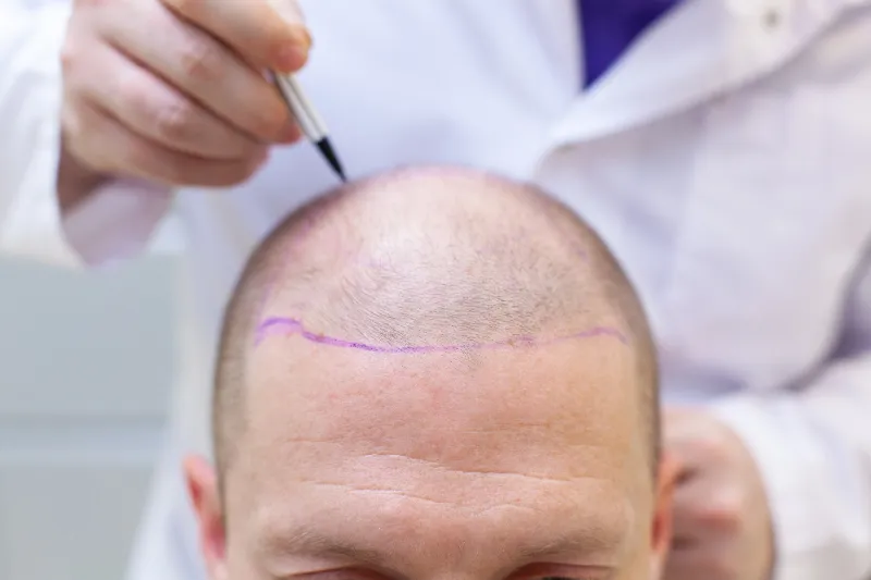 Rise of Hair Transplants