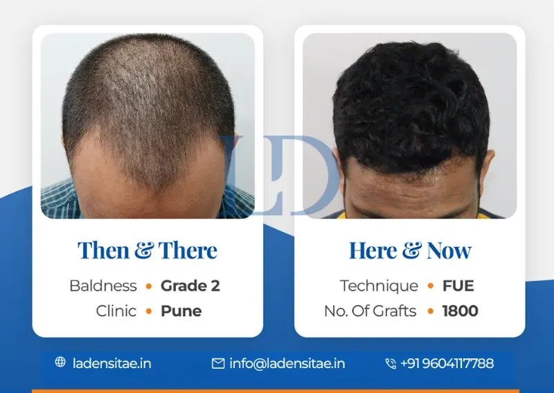 Transforming Your Appearance with Hair Transplant