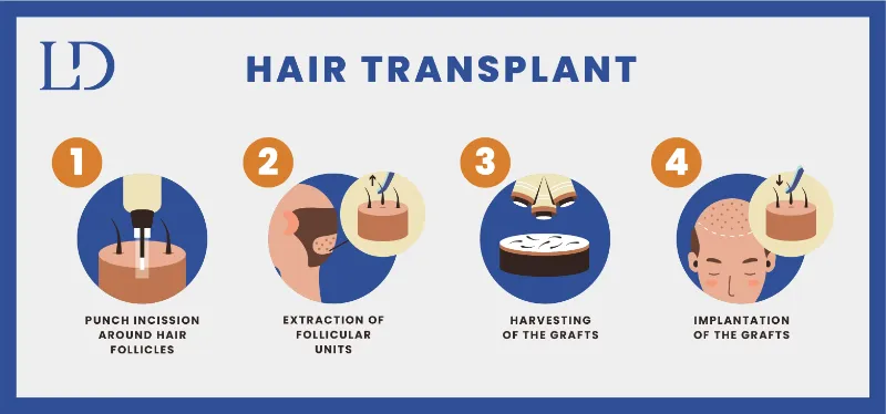 hair loss treatment in Bangalore 