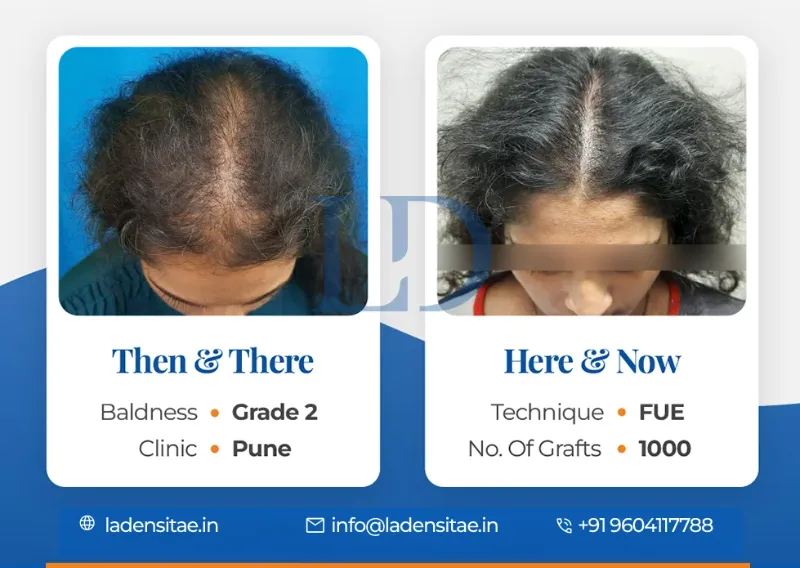 The Best Hair Treatment Clinic in Pune