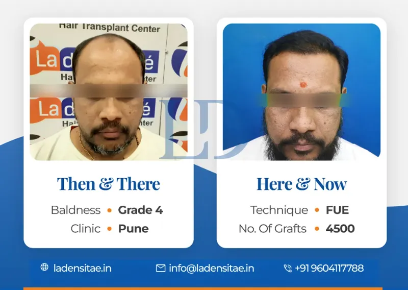 Achieving natural-looking results with FUE hair transplant