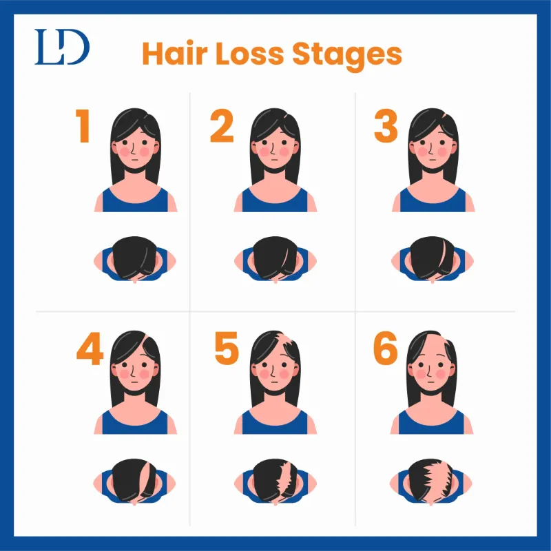 Stages of Hair Loss