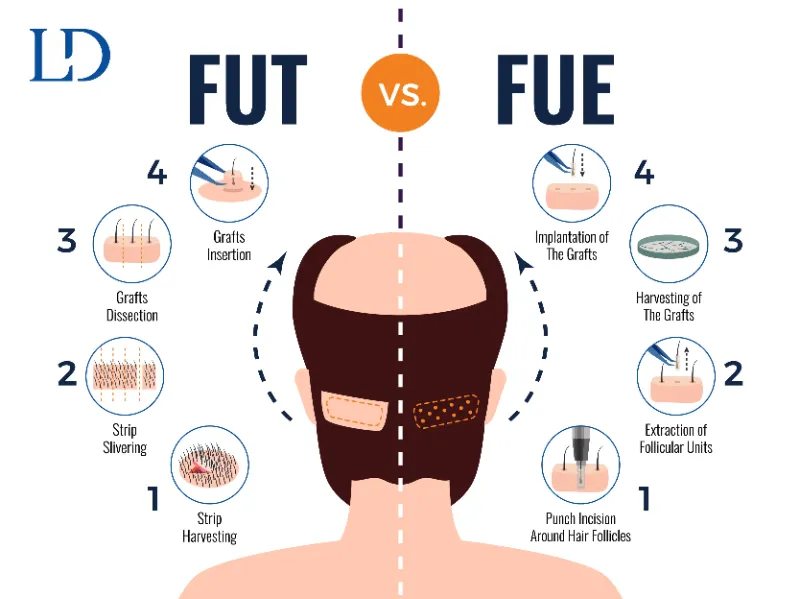 Hair Transplantation Techniques FUT and FUE