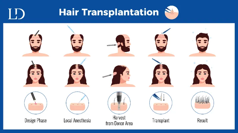 Hair Transplant Procedure FOR Men and Women