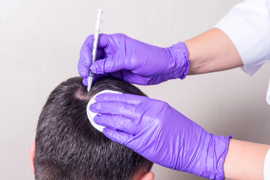 injection treatment hair loss (1)
