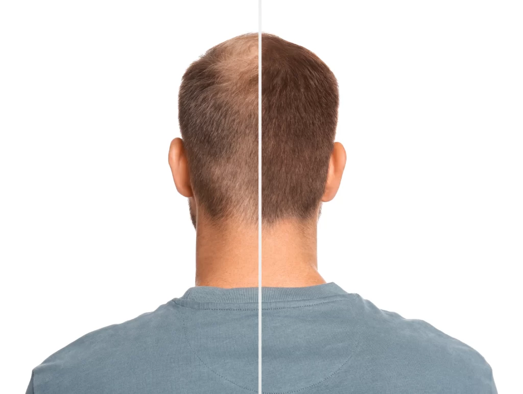 man with hair loss problem before after treatment white background collage visiting trichologist