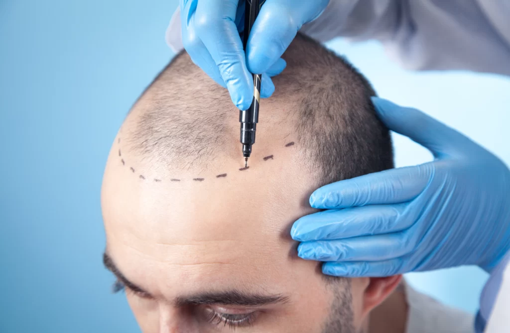 patient suffering from hair loss consultation with doctor doctor using skin marker
