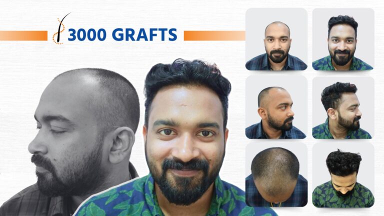 Sapphire FUE Before After