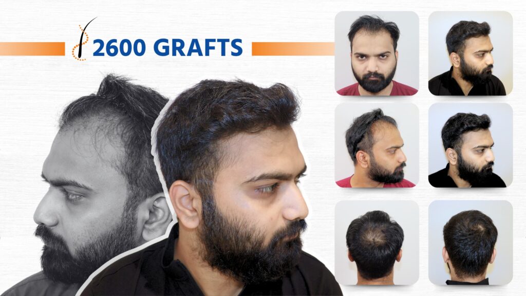 FUE Transplant Before After