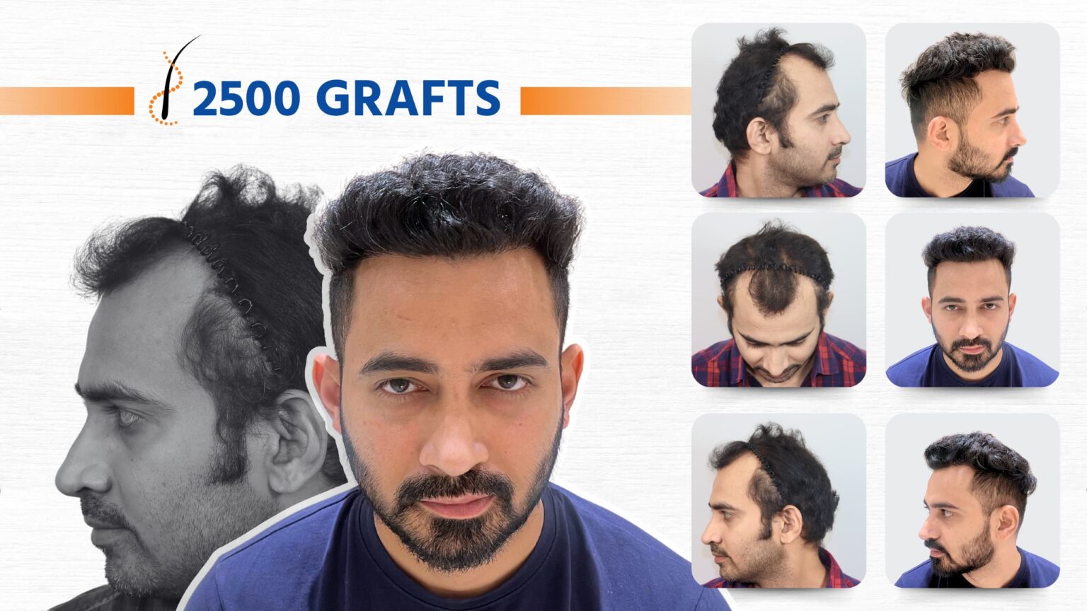 Beard Transplant Before After